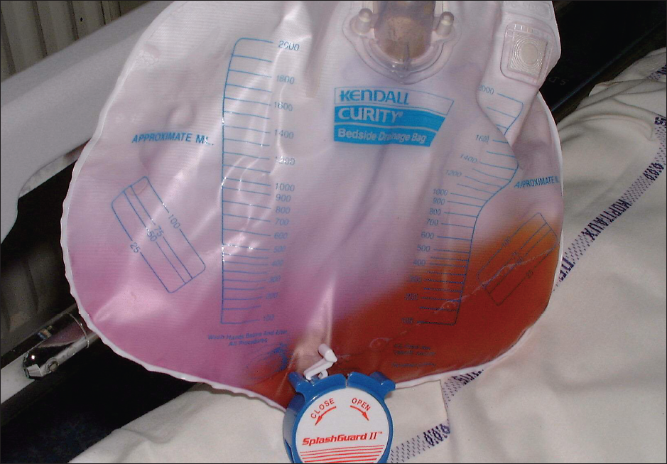 Something Bizarre in a Urine Collection Bag Consultant360